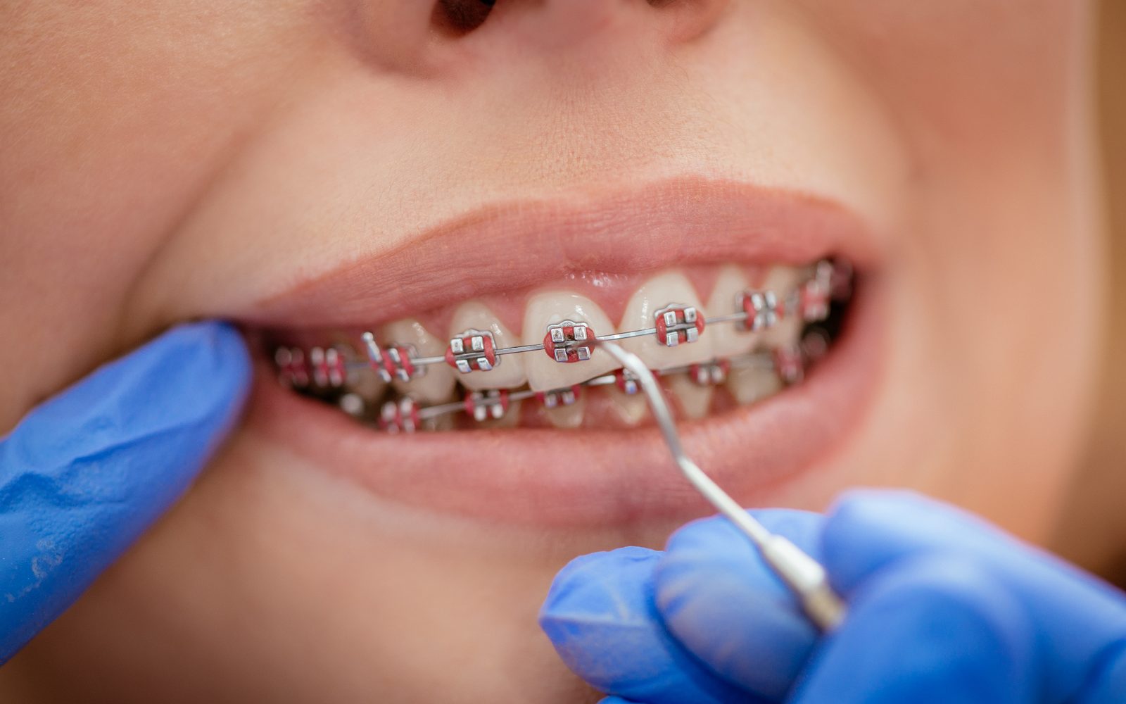 Close-up of a patient's smile with metal braces and red elastic ties being adjusted by a gloved orthodontist